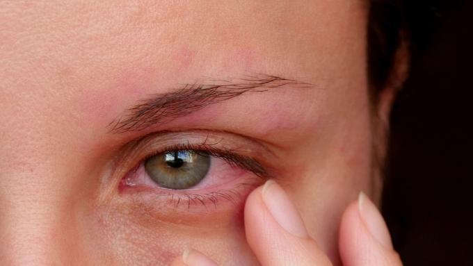 Przekrwione Oczy Przyczyny I Leczenie Czerwonych Oczu Choroby Polkipl 0808