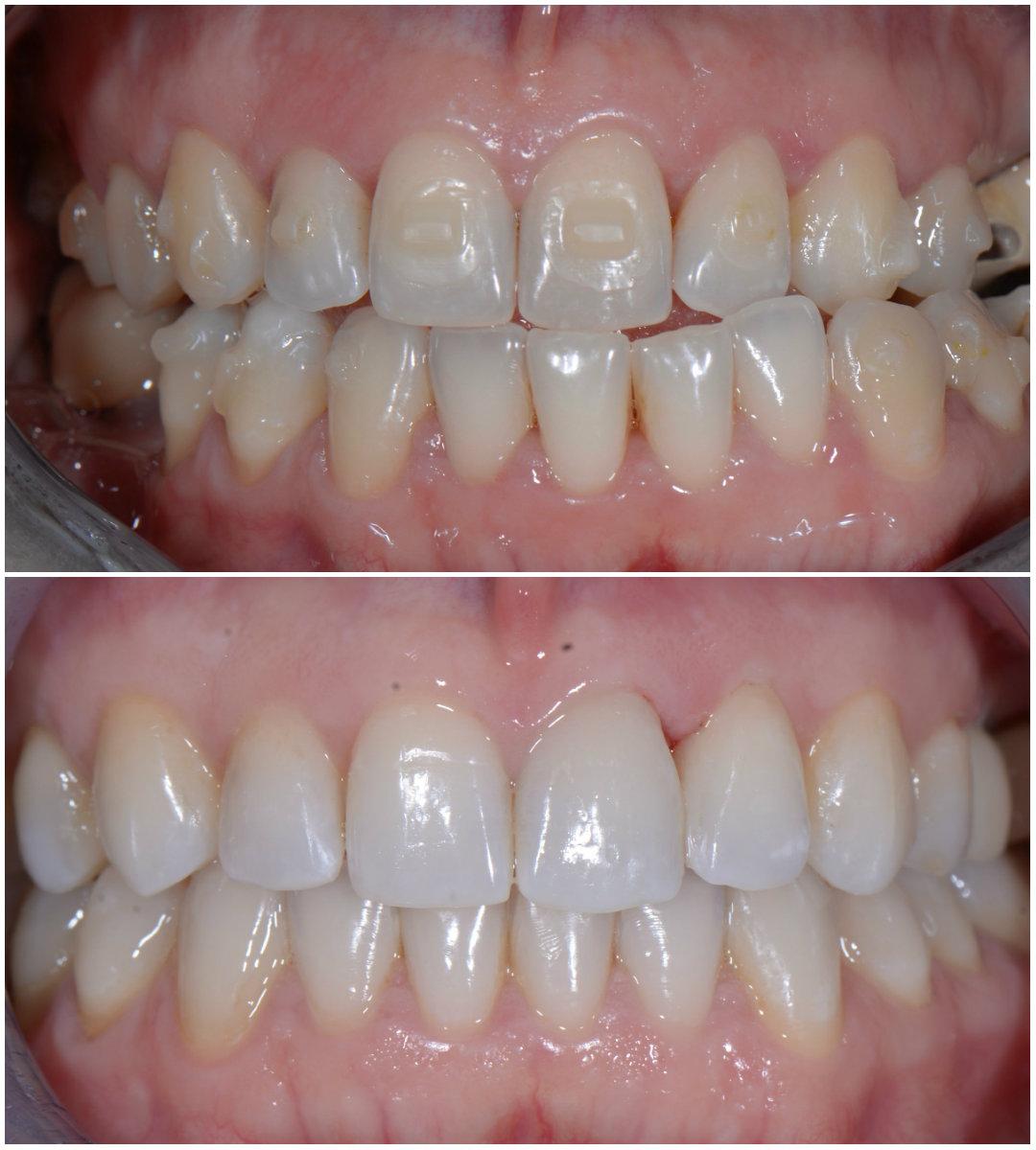 Aparat Ortodontyczny Przed I Po Jakie Sa Efekty Jego Noszenia Polki Pl