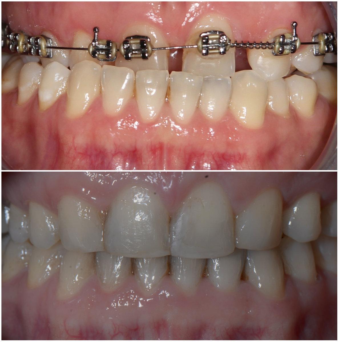 Aparat Ortodontyczny Przed I Po Jakie Sa Efekty Jego Noszenia Polki Pl
