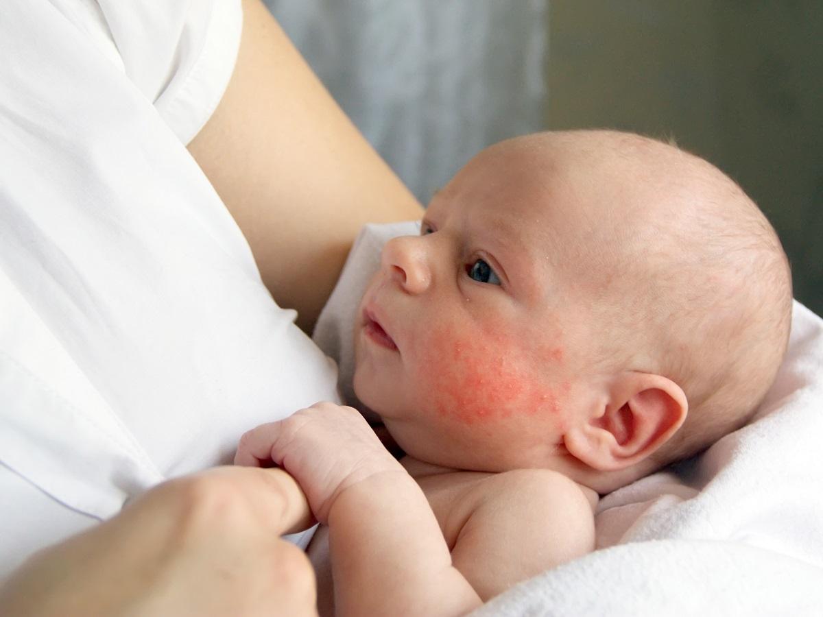 atopowe zapalenie skóry u dziecka