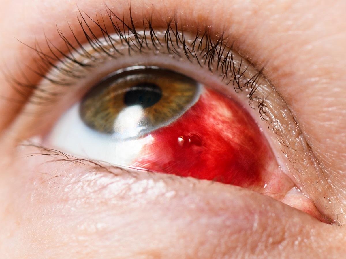 krwiak w oku uderzenie
