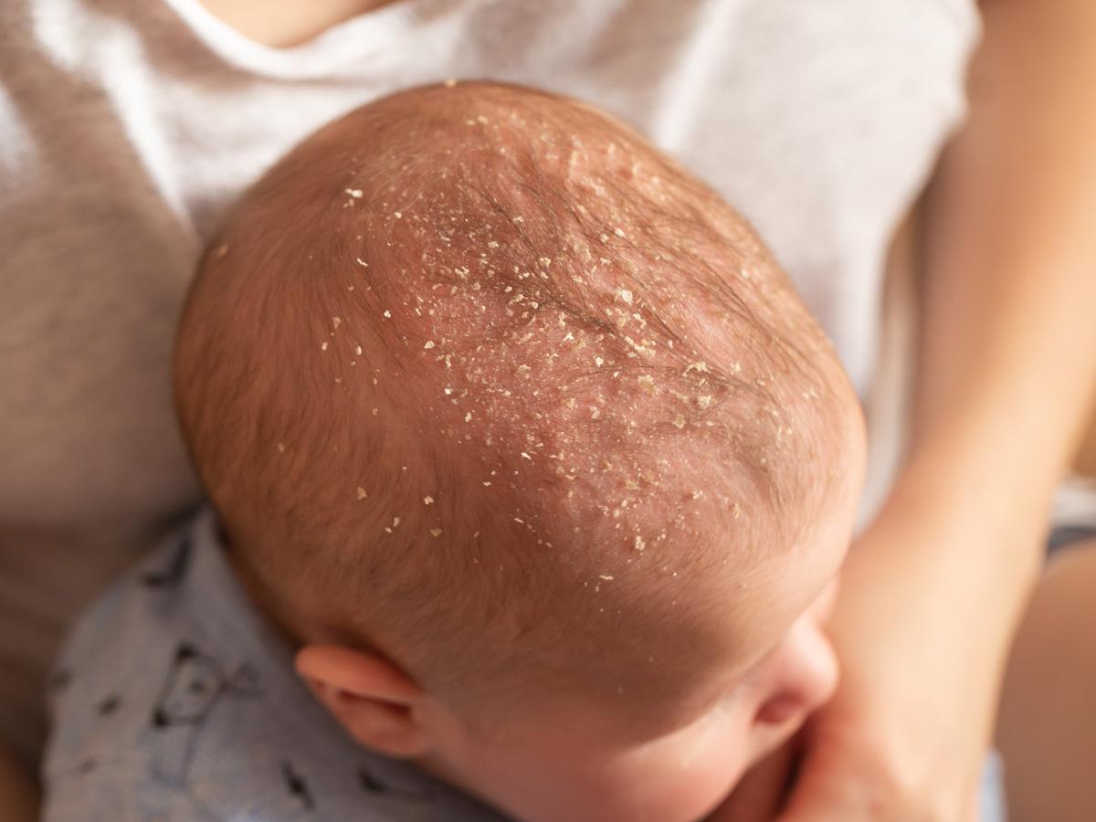 Łojotokowe zapalenie skóry u dzieci i niemowląt