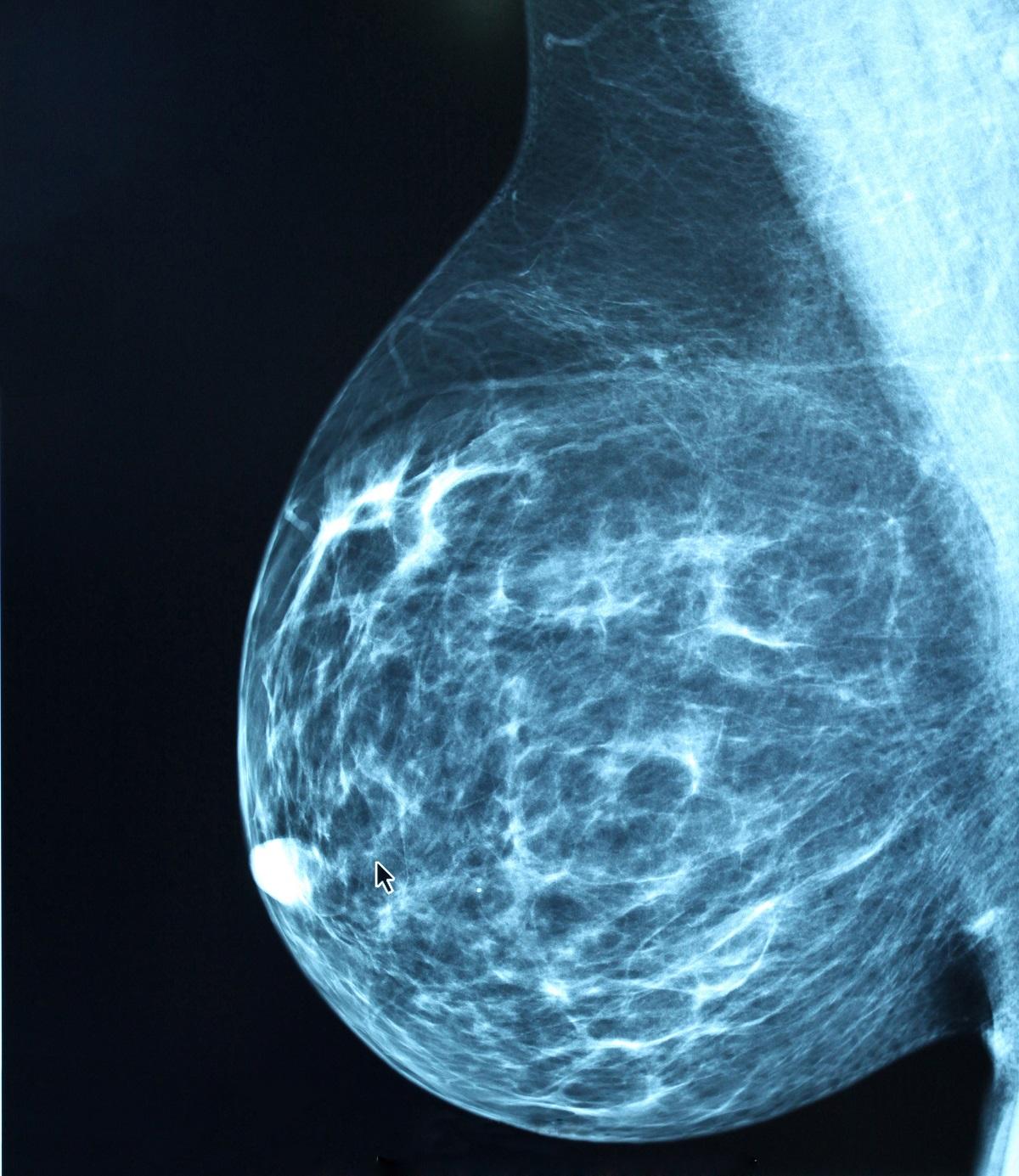 mammografia badanie