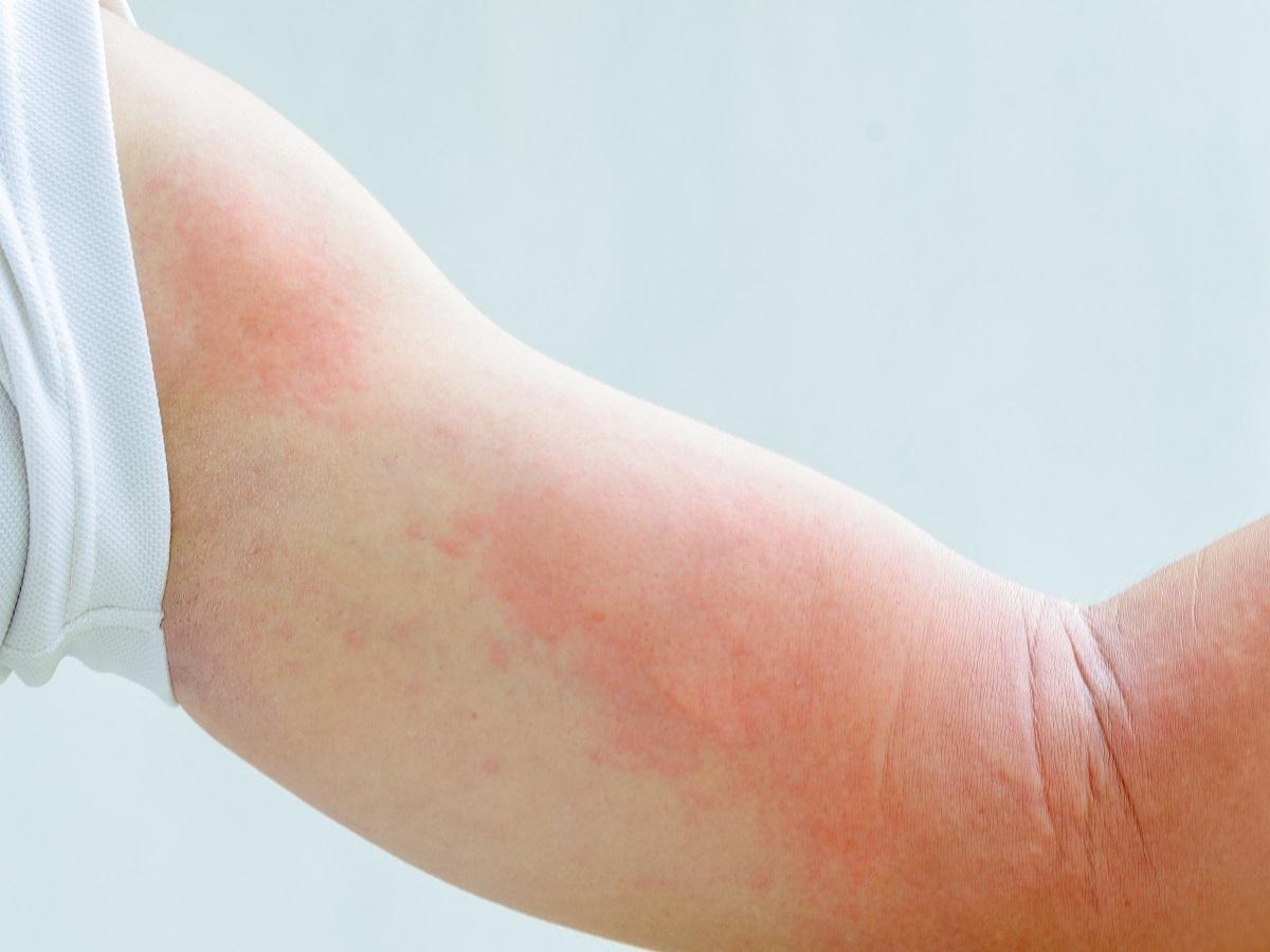 Objawy Alergii Jak Moze Sie Objawiac Uczulenie Choroby Polki Pl
