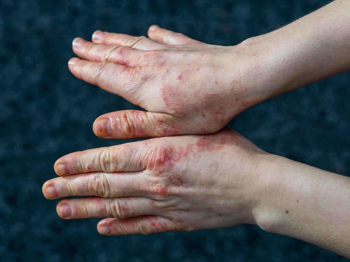 swędzące dłonie zapalenie skóry
