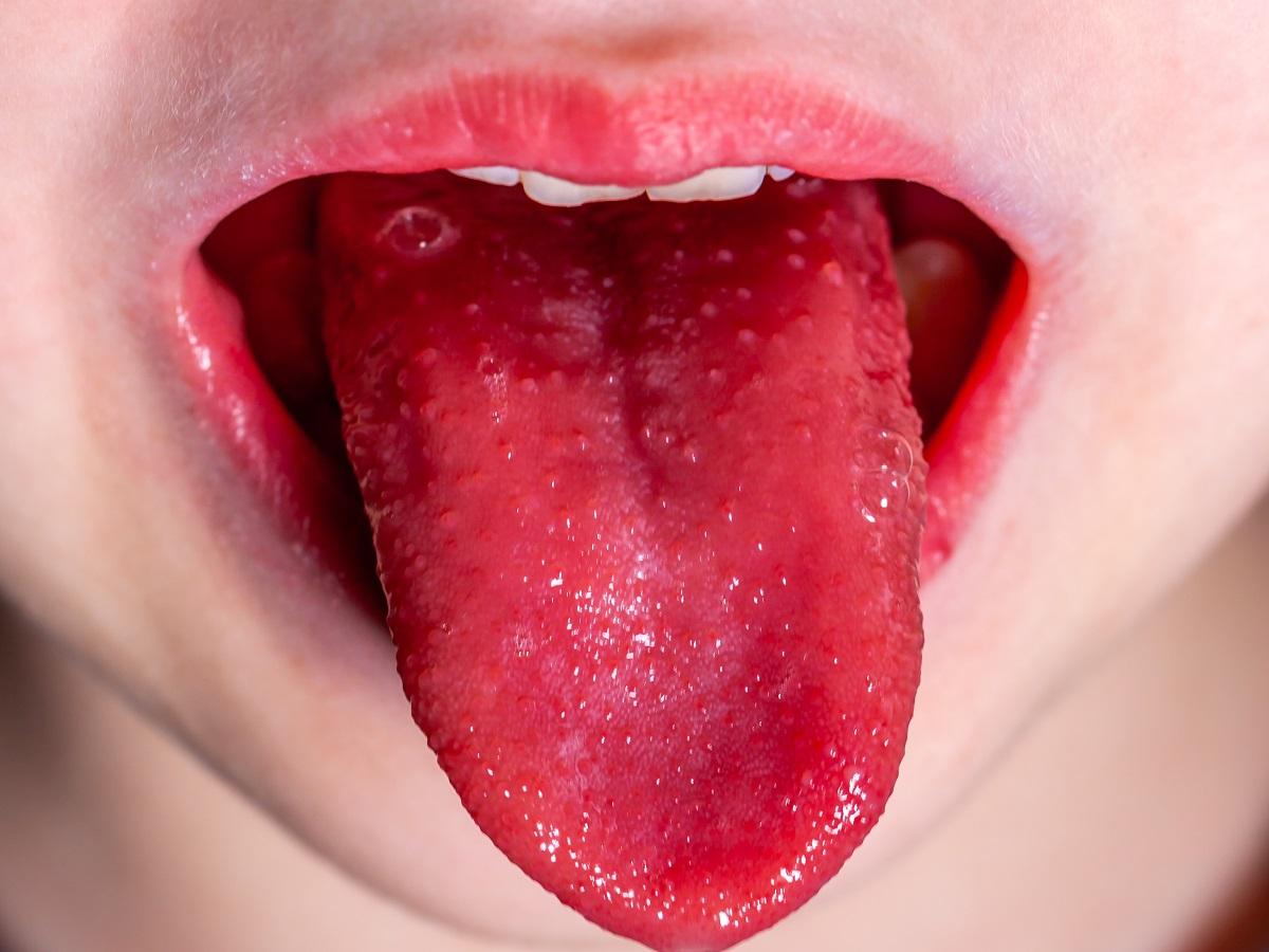 szkarlatyna malinowy język