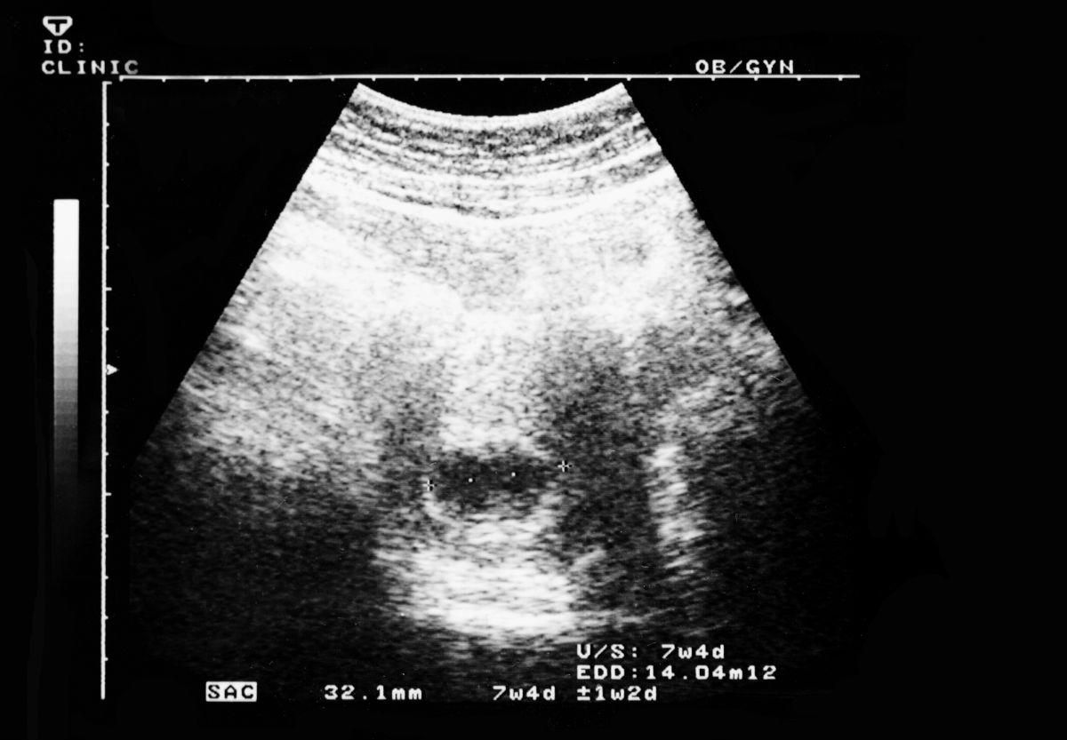 Co widać na USG w 7 tygodniu ciąży