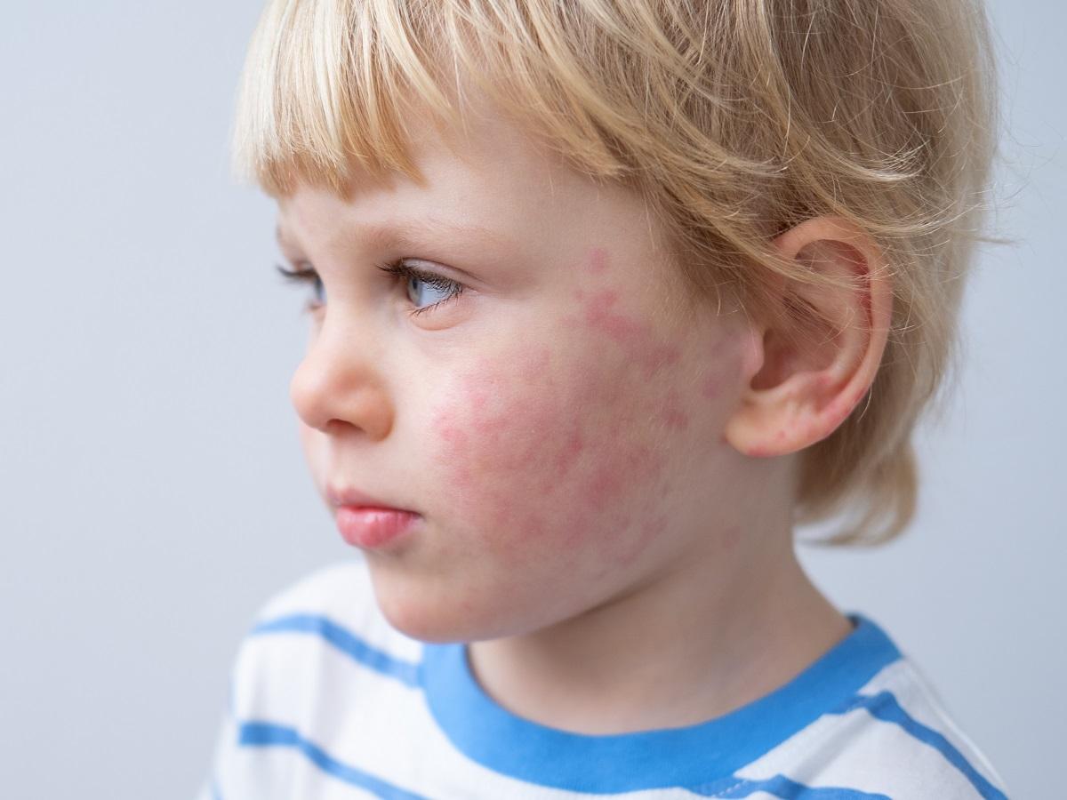 wysypka alergiczna u dziecka