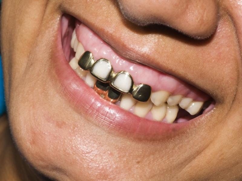Ile kosztuje wstawienie złotego zęba
