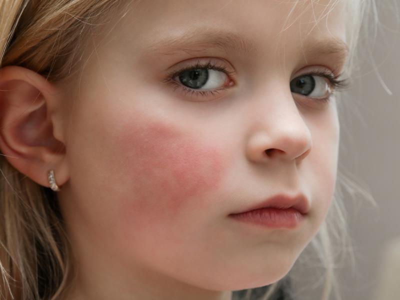 Rumień Zakaźny Piąta Choroba Przyczyny Objawy I Leczenie Dziecko 9261