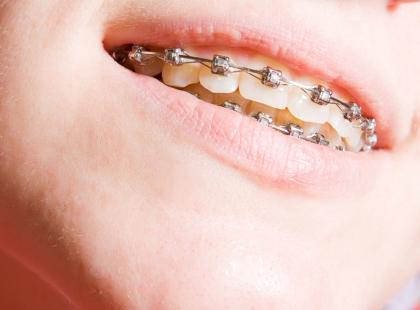Aparat ortodontyczny rodzaje cena