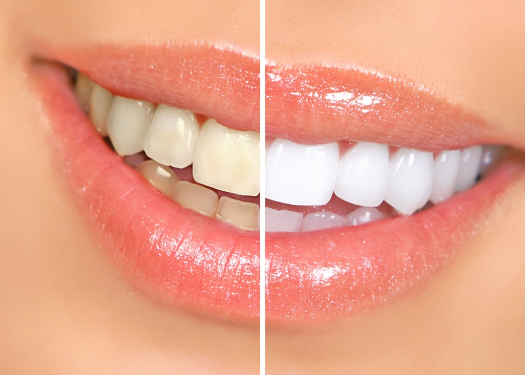 Wybielanie zębów cytryną efekty
