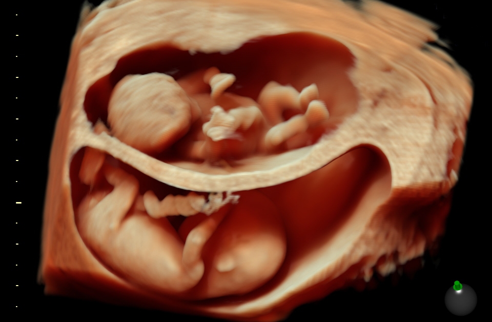 USG ciąży w 3D