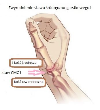 artroza stawu nadgarstka cum să îndepărtați durerile acute de genunchi