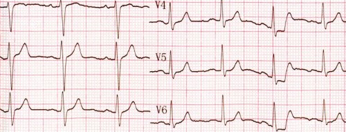 Wykres EKG