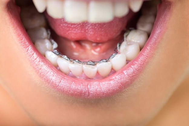 Obalamy 7 największych mitów o aparatach ortodontycznych